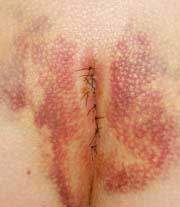scar 10 days after surgery