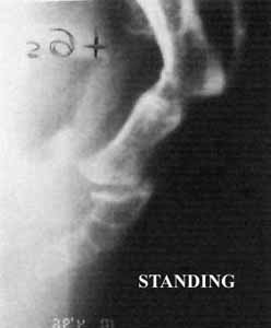 posterior luxation standing 1