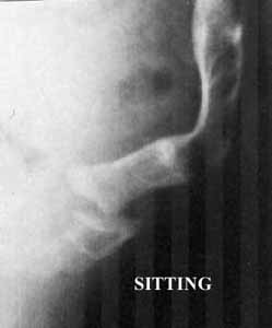 posterior luxation sitting 1