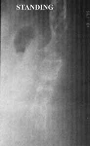 posterior luxation standing 2
