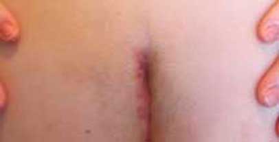 scar 3 weeks after surgery