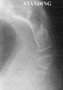 posterior luxation standing 3