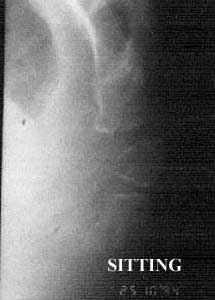 posterior luxation sitting 3