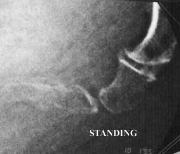 Hypermobility standing