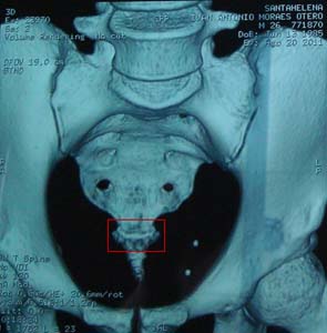 CT02 Pre-surgery