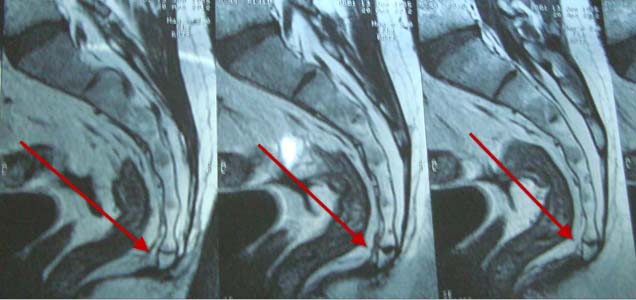 MRI Post-surgery
