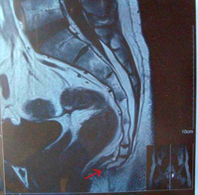 MRI Pre-surgery