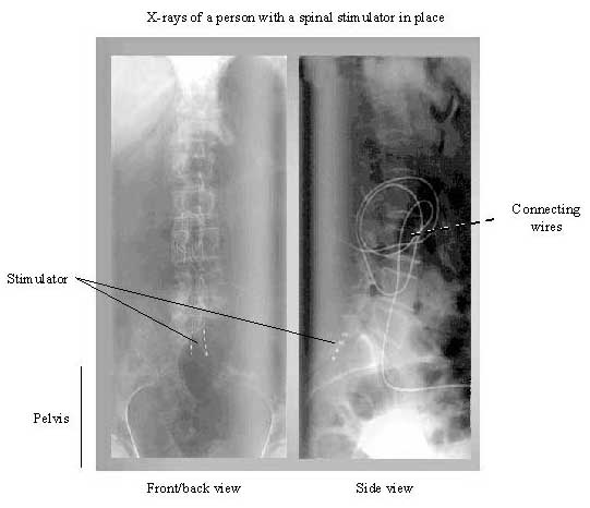 x-rays of a person with a spinal stimulator in place