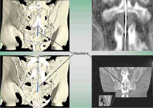 CAT and MRI scans of a person with a spinal stimulator in place