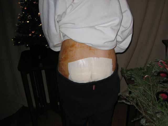 after surgery