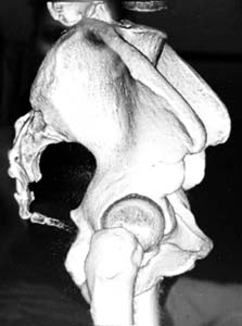 angled coccyx