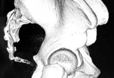 angled coccyx