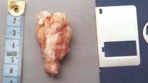 coccyx before cleaning