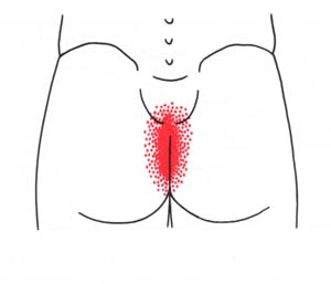 pain in the buttocks