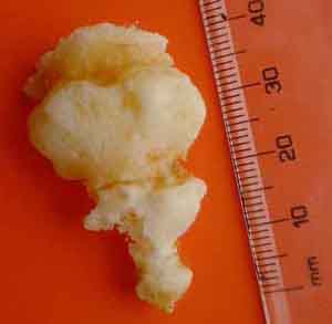 coccyx