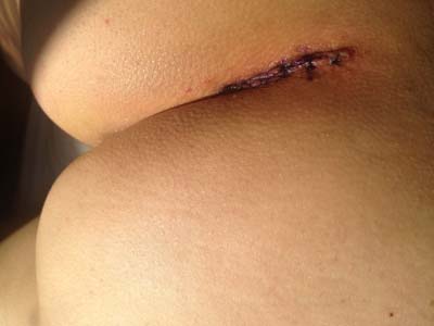 coccygectomy day 3