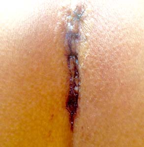 coccygectomy day 3
