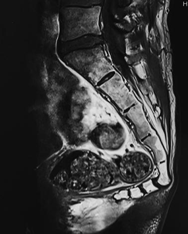 protruding sacrum mri