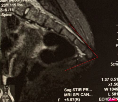 Coccyx angled 100 degrees