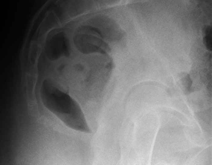 Hooked coccyx
