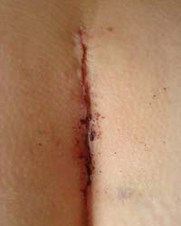 scar at day 7