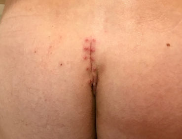 day after dressing off