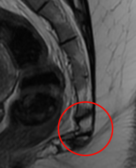 coccyx deformity