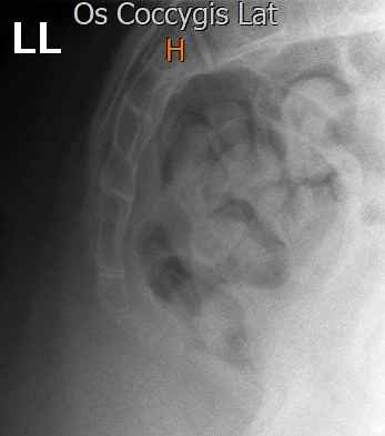 Hooked coccyx