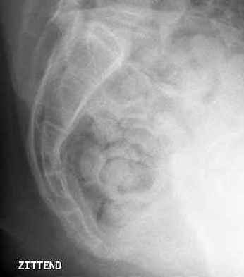 Hooked coccyx