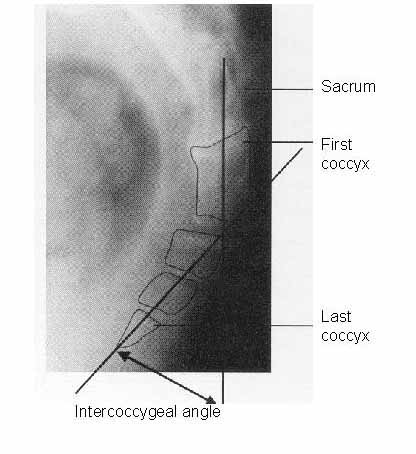 intercoccygeal angle