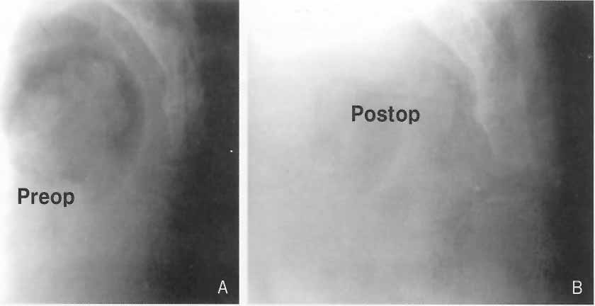 Preoperative and postoperative radiographs