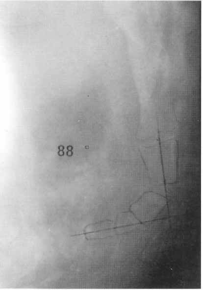 Radiograph of idiopathic coccygodynia