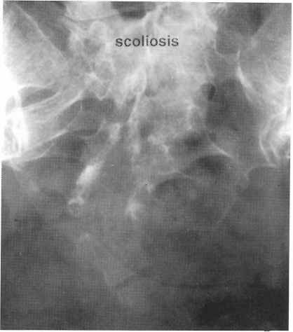 scoliosis