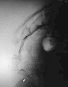 coccyx x-ray
