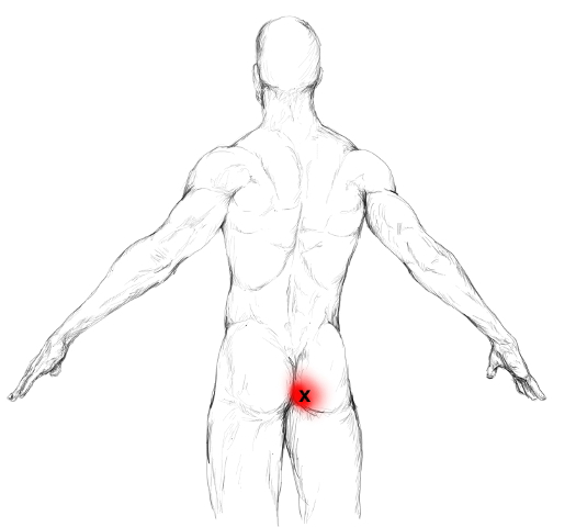 Gluteus maximum trigger point