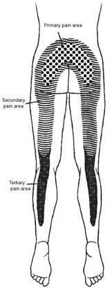 Lumbar Facet Syndrome Pain Referral Map