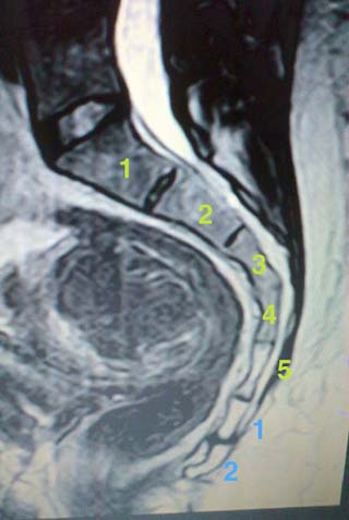 MRI