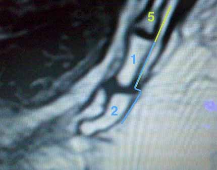 MRI detail
