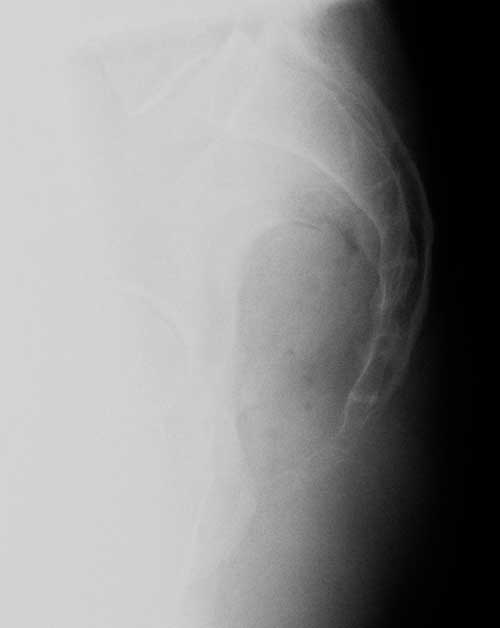 John's coccyx