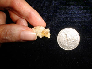 coccyx with spicule