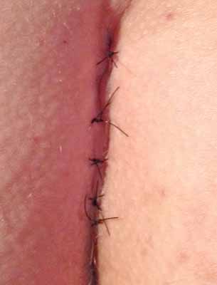 4 days after surgery