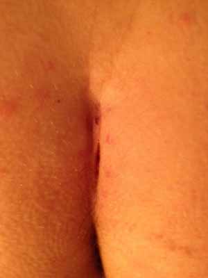 21 days post op