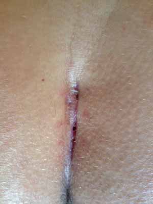 23 days post op