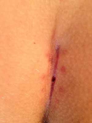 25 days post op