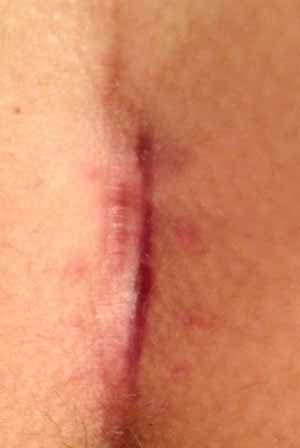 4 weeks post op