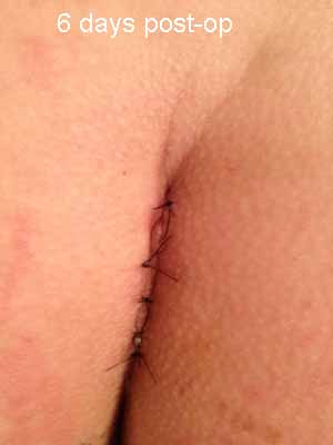 6 days post op