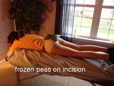 frozen peas on incision