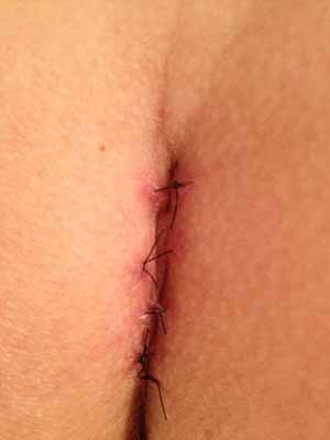12 days post op