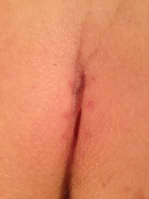 18 days post op