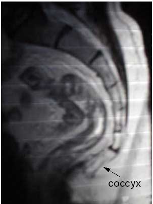 MRI scan